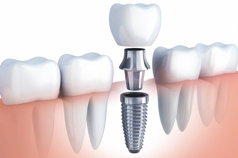 The Best Dental Implants: Everything You Need To Know