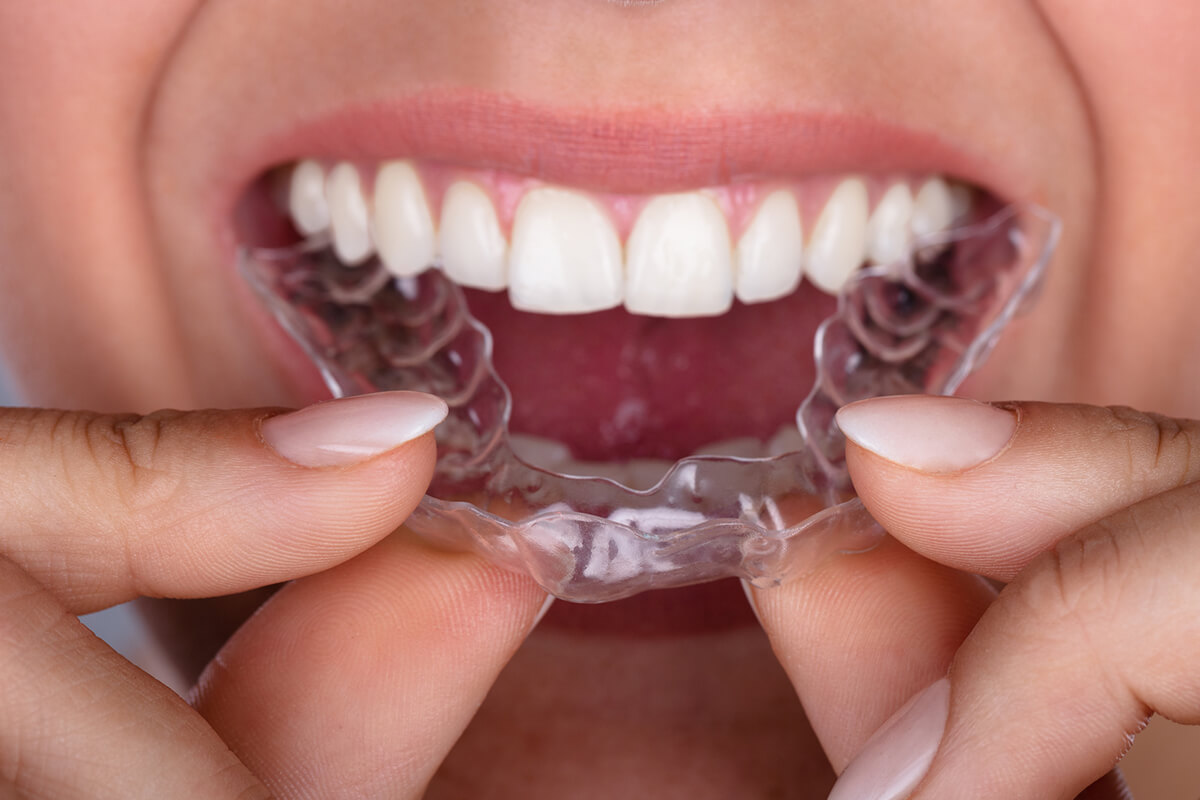 The Best Invisalign Treatment Options For A Perfect Smile